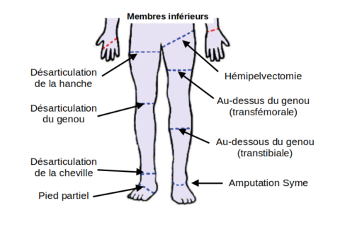 Amputations des membres inférieurs ADEPA